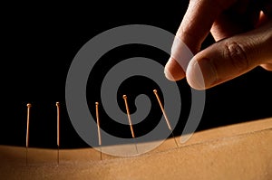 Acupuncture