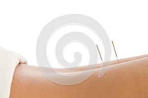 Acupuncture