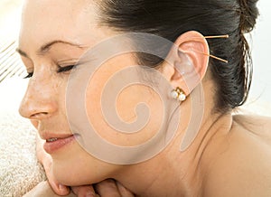 Acupuncture