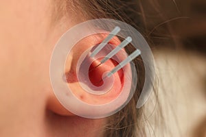 Acupuncture of the ear with three needles, ear with holes