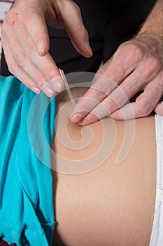 Acupuncture female patient back by Reflexologist photo