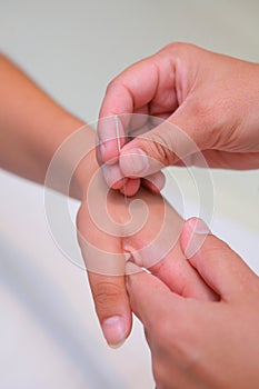 Acupuncture - inserting a needle
