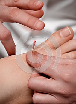 Acupuncture needle being tapped into foot