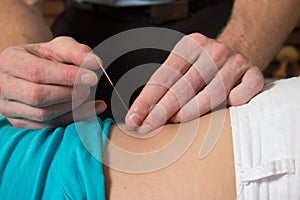 Acupuncture needle female patient back and spine