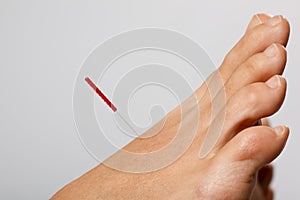 Acupuncture needle in foot