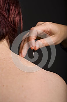 Acupuncture needle on shoulder