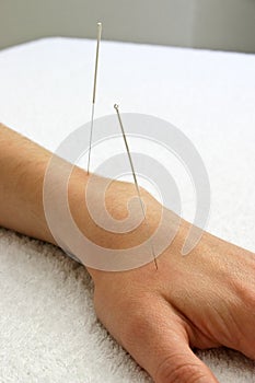 Acupuncture needles in hand