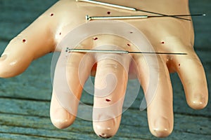 Acupuncture needles on hand model