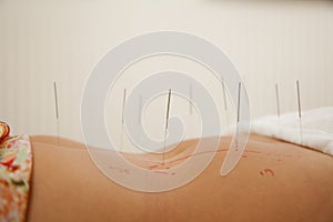 Acupuncture Needles in a Woman's Midsection