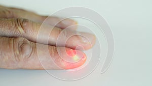 Acupuncture therapy with laser