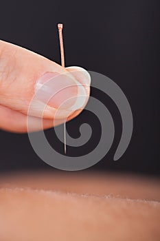 Acupuncture treatment