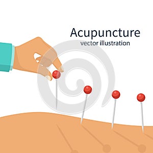 Acupuncture treatment closeup