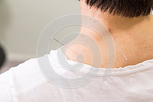 Acupuncturist needle pricking into skin, with shallow depth of f