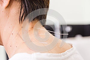 Acupuncturist needle pricking into skin, with shallow depth of f