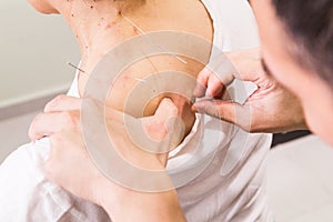 Acupuncturist pricking needle into skin, with shallow depth of f