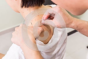 Acupuncturist pricking needle into skin, with shallow depth of f