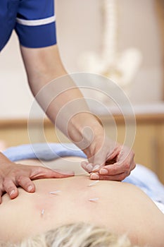 Acupuncturist treating female client