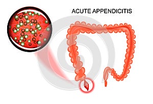 Acute appendicitis. bacteria photo