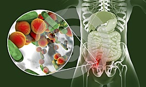 Acute appendicitis illustration