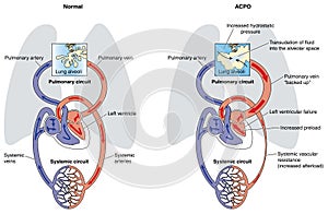 Acute cardiogenic pulmonary oedema