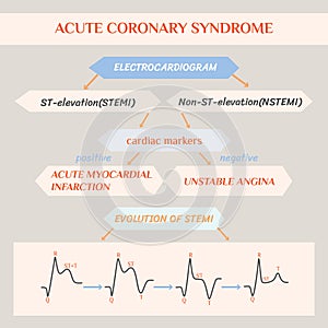 Acute coronary syndrome. Schematic Electrocardiogram of myocardial infarction (heart attack