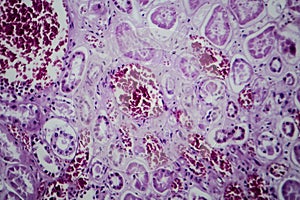 Acute glomerulonephritis, light micrograph