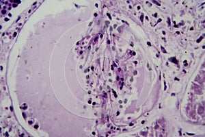 Acute glomerulonephritis, light micrograph