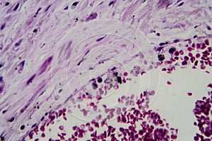 Acute glomerulonephritis, light micrograph photo