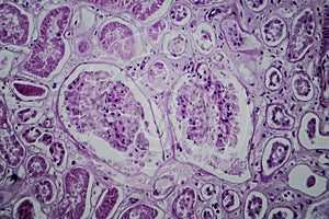 Acute glomerulonephritis, light micrograph photo