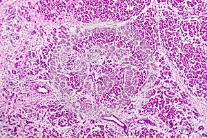 Acute hemorrhagic pancreatitis