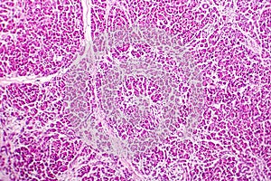 Acute hemorrhagic pancreatitis