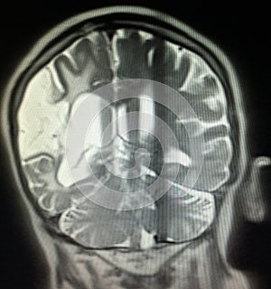 Acute infarction brain mri examination stroke