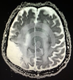 Acute infarction brain mri examination stroke