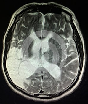 Acute infarction brain mri examination stroke photo