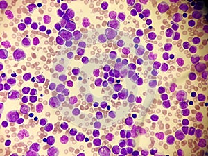 Acute leukemia in a blood smear. Hematology. photo