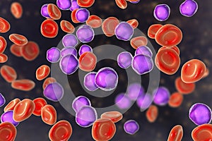 Acute lymphoblastic leukemia