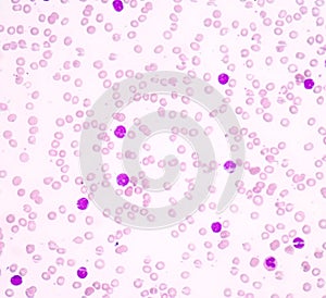 Acute lymphoblastic leukemia(ALL)