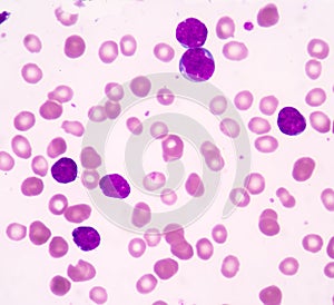 Acute lymphoblastic leukemia(ALL)