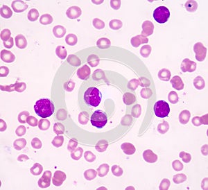 Acute lymphoblastic leukemia(ALL)