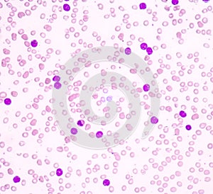 Acute lymphoblastic leukemia(ALL)