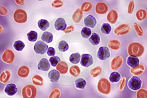 Acute lymphoblastic leukemia, bone marrow smear