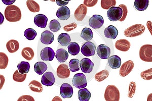 Acute lymphoblastic leukemia, bone marrow smear