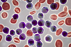 Acute lymphoblastic leukemia, bone marrow smear