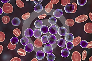 Acute lymphoblastic leukemia, bone marrow smear