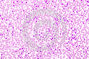 Acute lymphocytic leukemia or ALL cells