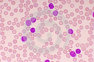 Acute lymphocytic leukemia or ALL cells in blood smear