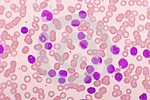 Acute lymphocytic leukemia or ALL cells in blood smear