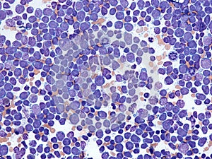 Acute lymphoid leukemia in bone marrow.