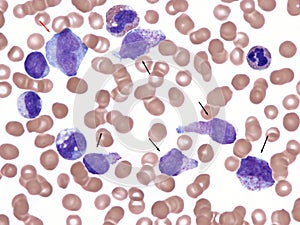 Acute mast cell leukemia. photo