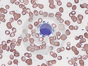 Acute megakaryoblastic leukemia.